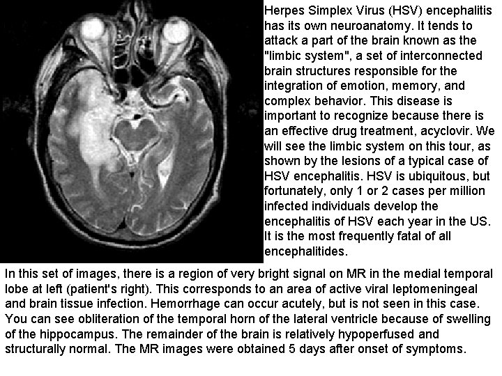 Herpes Simplex Virus (HSV) encephalitis has its own neuroanatomy. It tends to attack a Herpes Simplex Virus (HSV) encephalitis has its own neuroanatomy. It tends to attack a