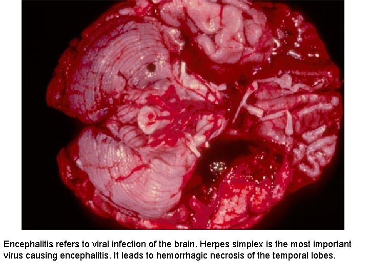 Encephalitis refers to viral infection of the brain. Herpes simplex is the most important Encephalitis refers to viral infection of the brain. Herpes simplex is the most important