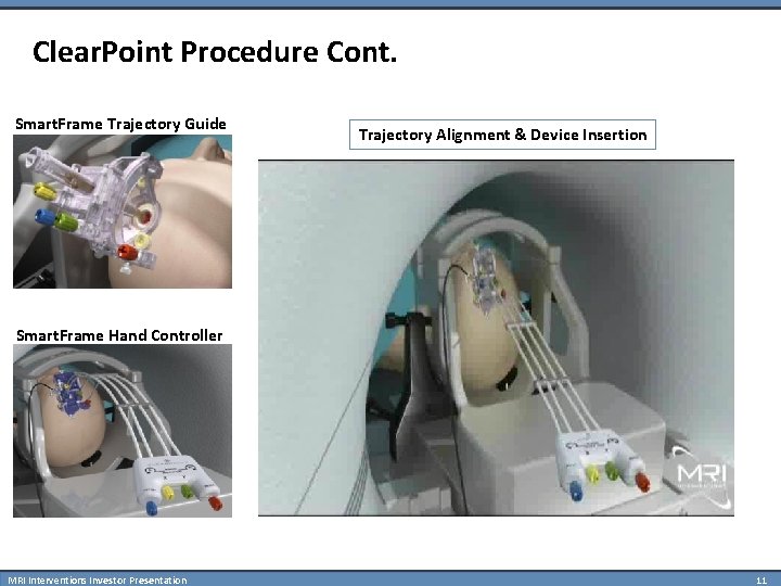 Clear. Point Procedure Cont. Smart. Frame Trajectory Guide Trajectory Alignment & Device Insertion Smart.