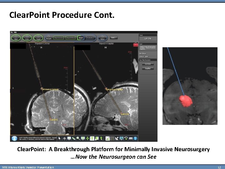 Clear. Point Procedure Cont. Clear. Point: A Breakthrough Platform for Minimally Invasive Neurosurgery …Now