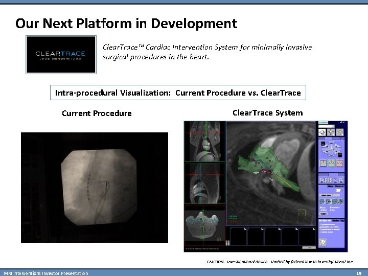 Our Next Platform in Development Clear. Trace™ Cardiac Intervention System for minimally invasive surgical