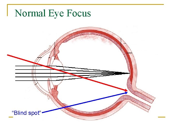 Normal Eye Focus “Blind spot” 