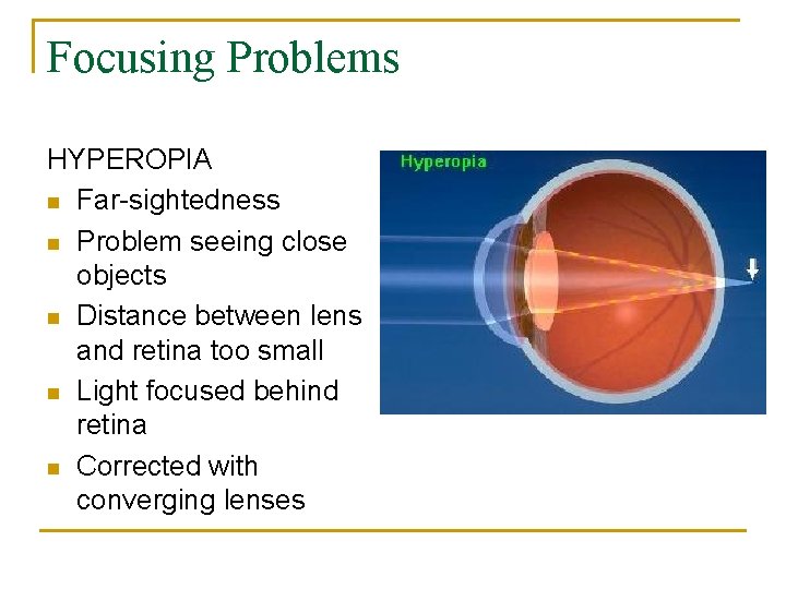 Focusing Problems HYPEROPIA n Far-sightedness n Problem seeing close objects n Distance between lens