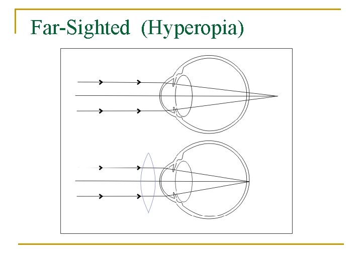 Far-Sighted (Hyperopia) 