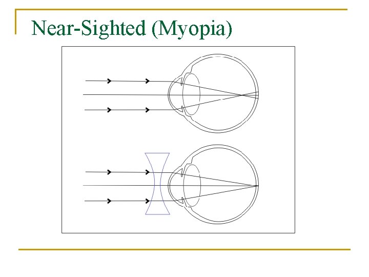 Near-Sighted (Myopia) 