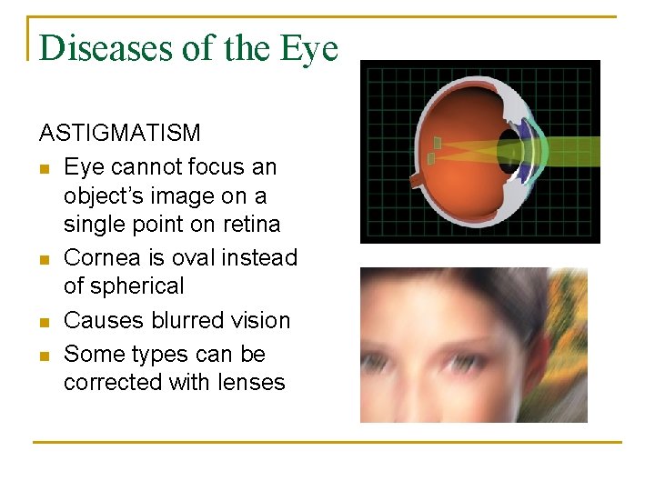Diseases of the Eye ASTIGMATISM n Eye cannot focus an object’s image on a