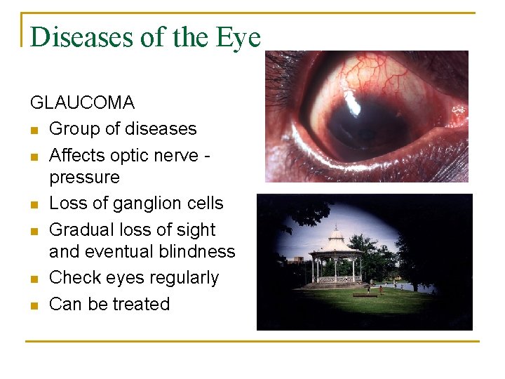 Diseases of the Eye GLAUCOMA n Group of diseases n Affects optic nerve pressure