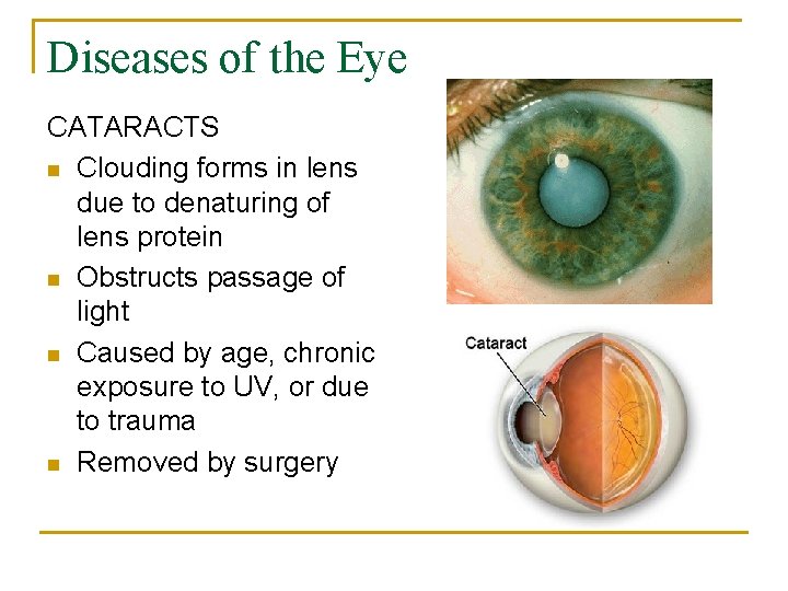Diseases of the Eye CATARACTS n Clouding forms in lens due to denaturing of