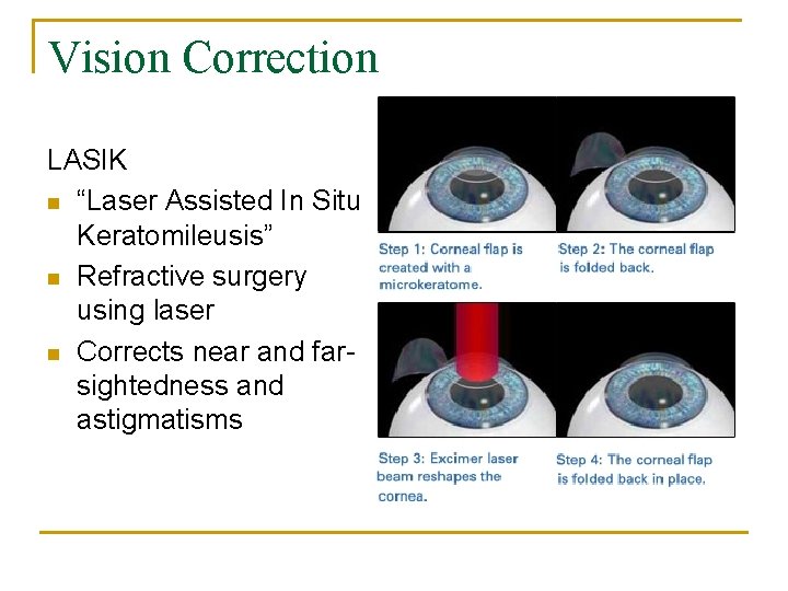 Vision Correction LASIK n “Laser Assisted In Situ Keratomileusis” n Refractive surgery using laser