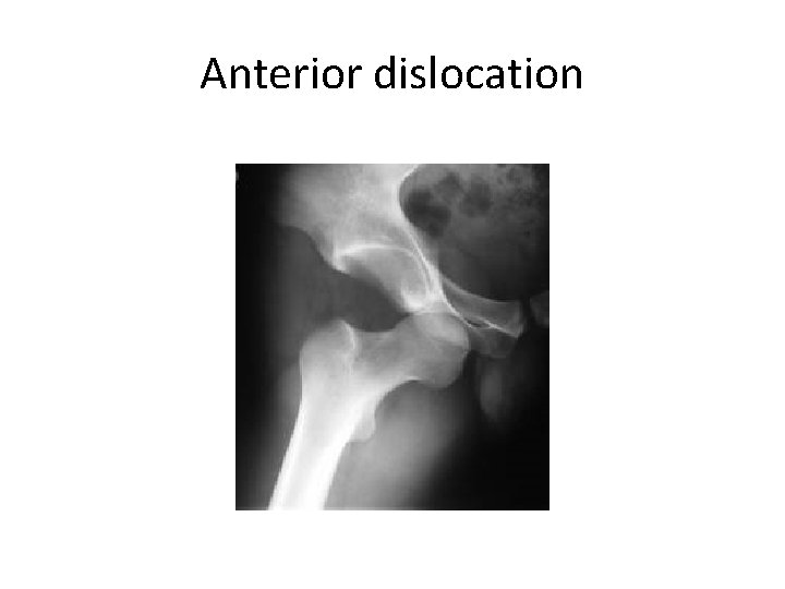 Anterior dislocation 