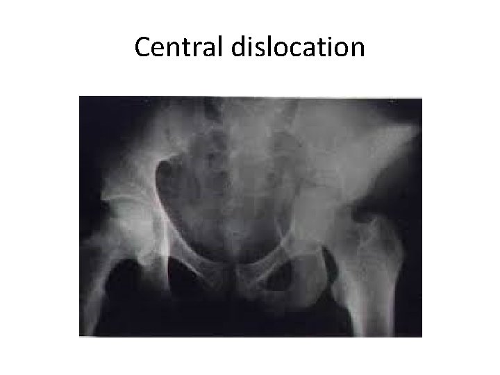 Central dislocation 