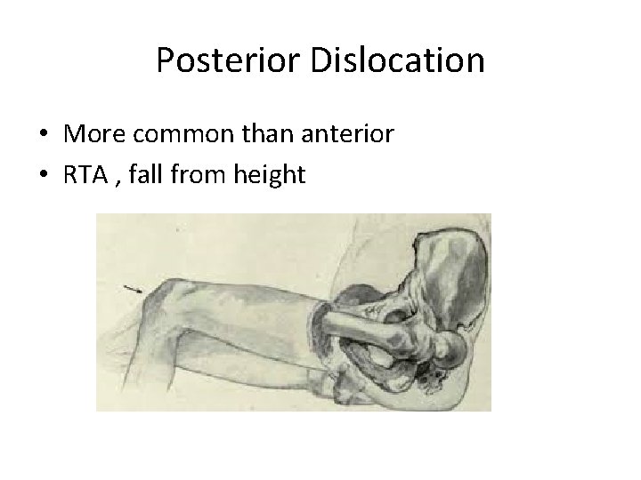 Posterior Dislocation • More common than anterior • RTA , fall from height 