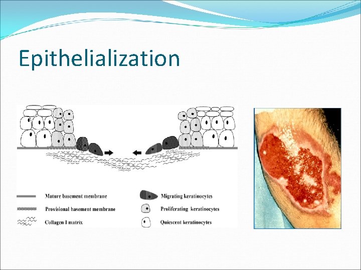 Epithelialization 