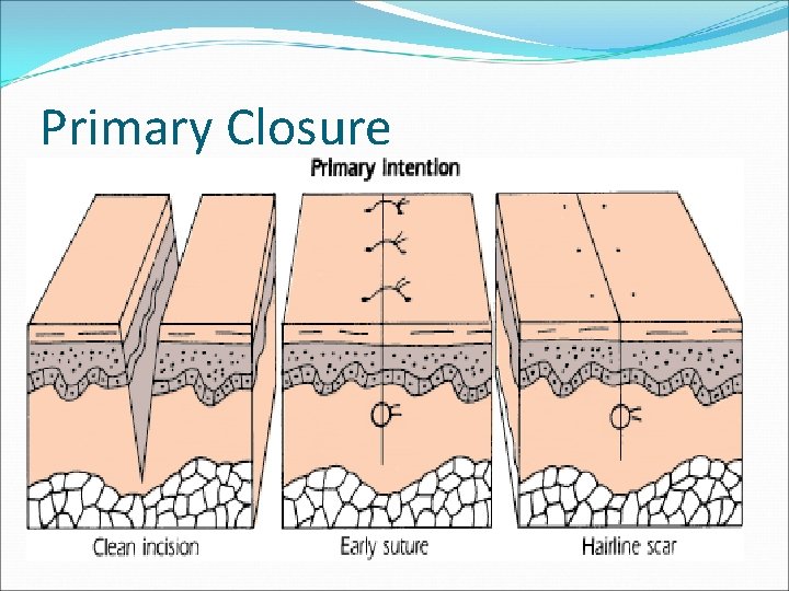 Primary Closure 