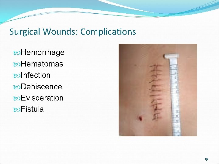 Surgical Wounds: Complications Hemorrhage Hematomas Infection Dehiscence Evisceration Fistula 19 