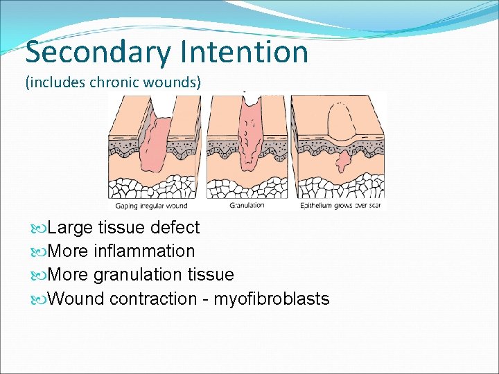 Secondary Intention (includes chronic wounds) Large tissue defect More inflammation More granulation tissue Wound