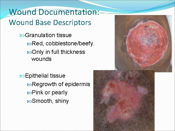 Wound Documentation: Wound Base Descriptors Granulation tissue Red, cobblestone/beefy. Only in full thickness wounds