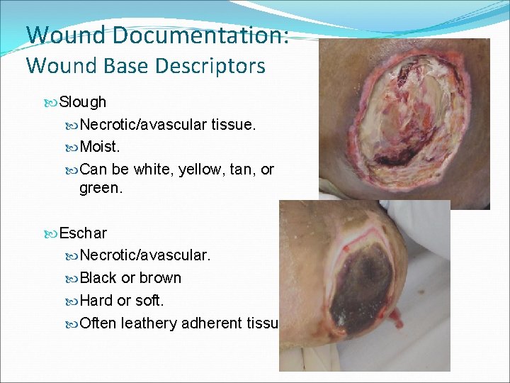 Wound Documentation: Wound Base Descriptors Slough Necrotic/avascular tissue. Moist. Can be white, yellow, tan,