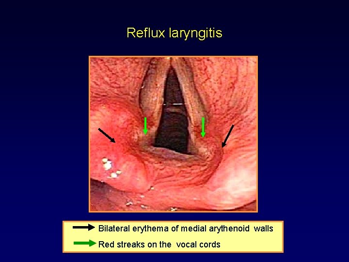 Reflux laryngitis Bilateral erythema of medial arythenoid walls Red streaks on the vocal cords