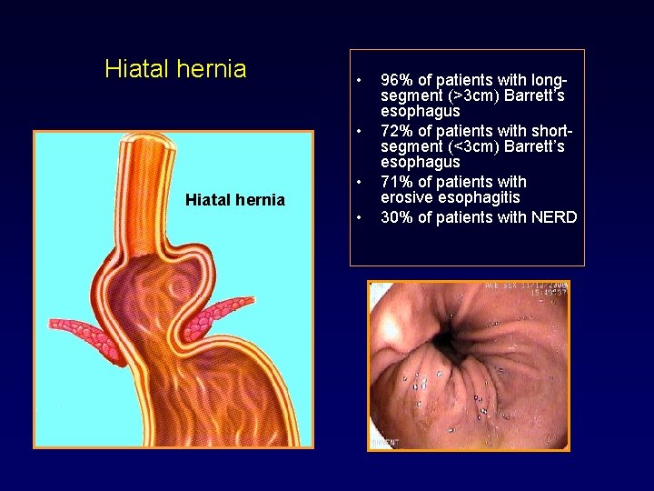 Hiatal hernia • • 96% of patients with longsegment (>3 cm) Barrett’s esophagus 72%