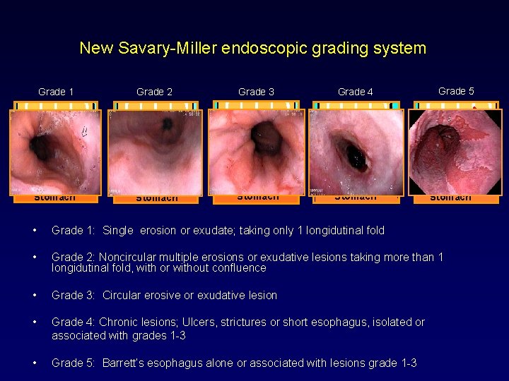 New Savary-Miller endoscopic grading system Grade 1 Grade 2 Grade 3 Grade 4 Stomach