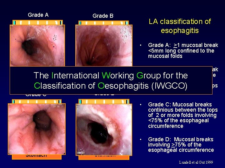 Grade A Grade B LA classification of esophagitis • Grade A: >1 mucosal break