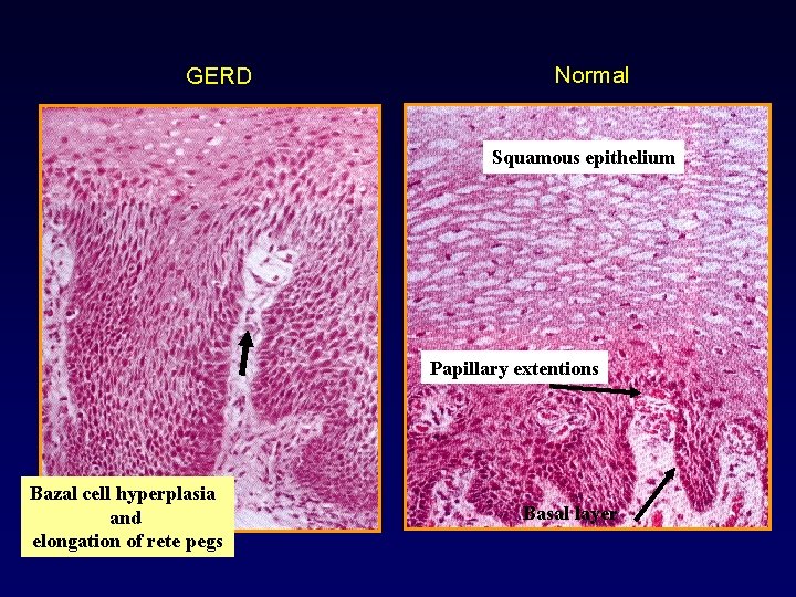 GERD Normal Squamous epithelium Papillary extentions Bazal cell hyperplasia and elongation of rete pegs