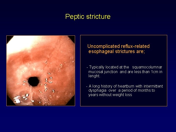 Peptic stricture Uncomplicated reflux-related esophageal strictures are; - Typically located at the squamocolumnar mucosal