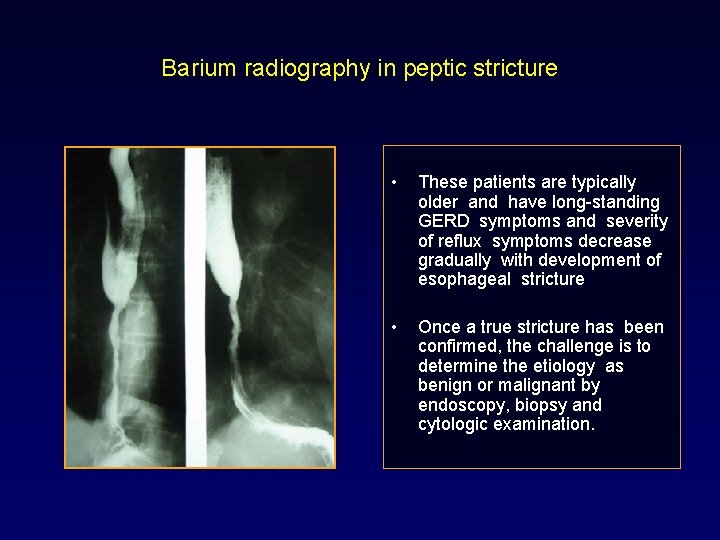 Barium radiography in peptic stricture • These patients are typically older and have long-standing