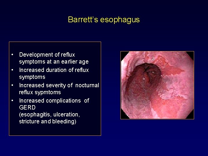 Barrett’s esophagus • Development of reflux symptoms at an earlier age • Increased duration