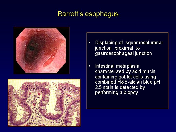 Barrett’s esophagus • Displacing of squamocolumnar junction proximal to gastroesophageal junction • Intestinal metaplasia