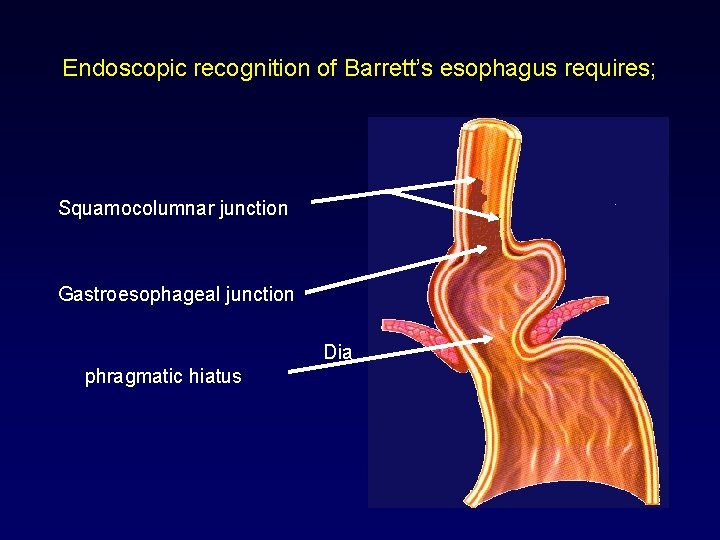 Endoscopic recognition of Barrett’s esophagus requires; Squamocolumnar junction Gastroesophageal junction Dia phragmatic hiatus 