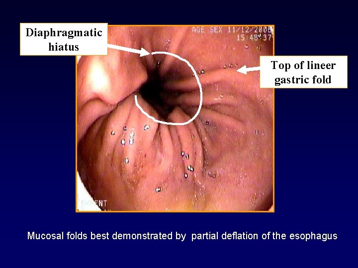 Diaphragmatic hiatus Top of lineer gastric fold Mucosal folds best demonstrated by partial deflation