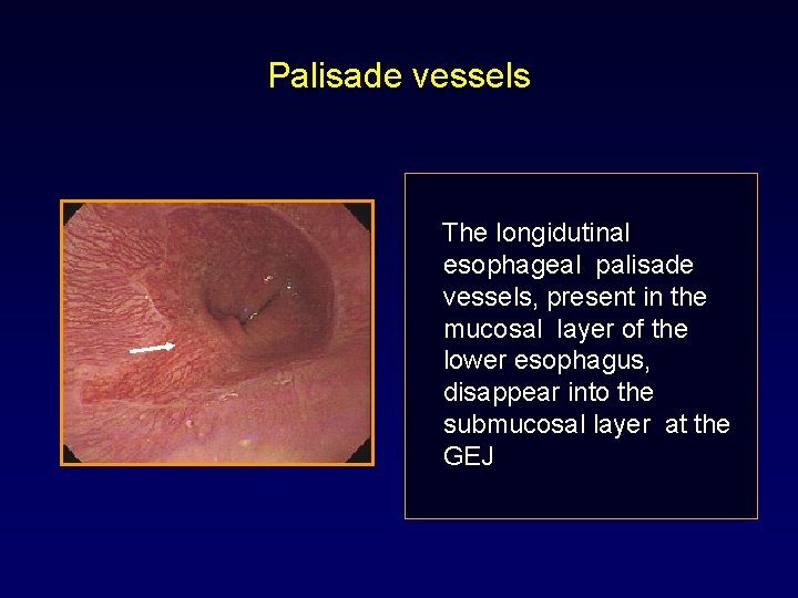 Palisade vessels The longidutinal esophageal palisade vessels, present in the mucosal layer of the