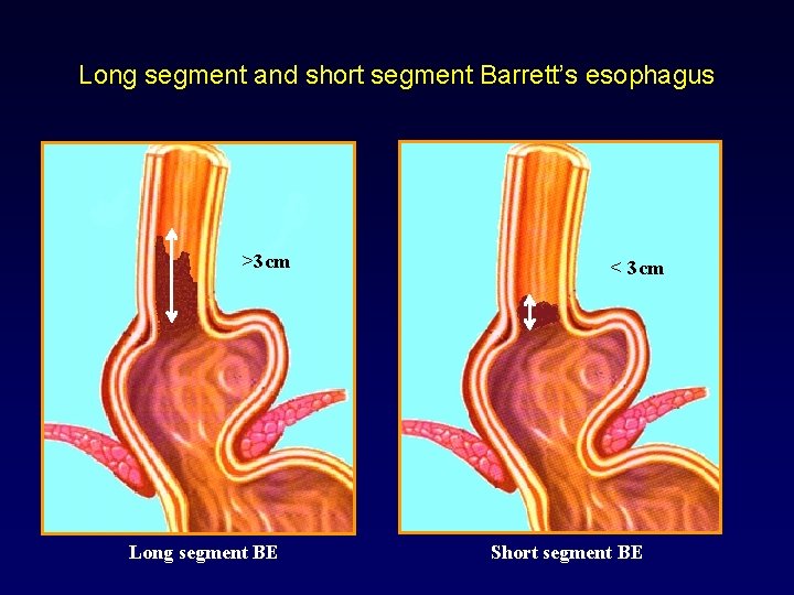 Long segment and short segment Barrett’s esophagus >3 cm Long segment BE < 3