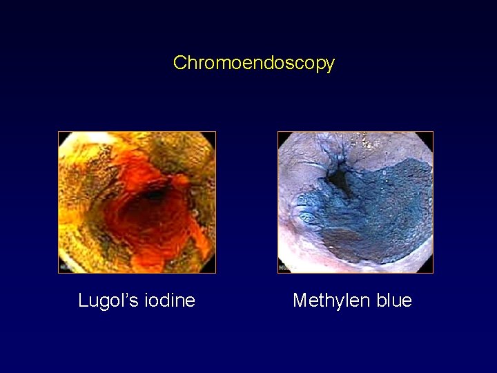 Chromoendoscopy Lugol’s iodine Methylen blue 