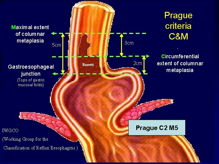 Maximal extent of columnar metaplasia 3 cm 5 cm Gastroesophageal junction Prague criteria C&M