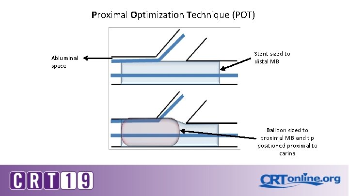 Proximal Optimization Technique (POT) Abluminal space Stent sized to distal MB Balloon sized to Proximal Optimization Technique (POT) Abluminal space Stent sized to distal MB Balloon sized to