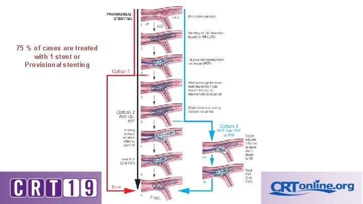 75 % of cases are treated with 1 stent or Provisional stenting 75 % of cases are treated with 1 stent or Provisional stenting