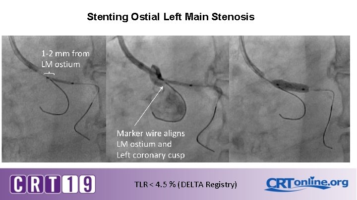 Stenting Ostial Left Main Stenosis TLR < 4. 5 % (DELTA Registry) Stenting Ostial Left Main Stenosis TLR < 4. 5 % (DELTA Registry)