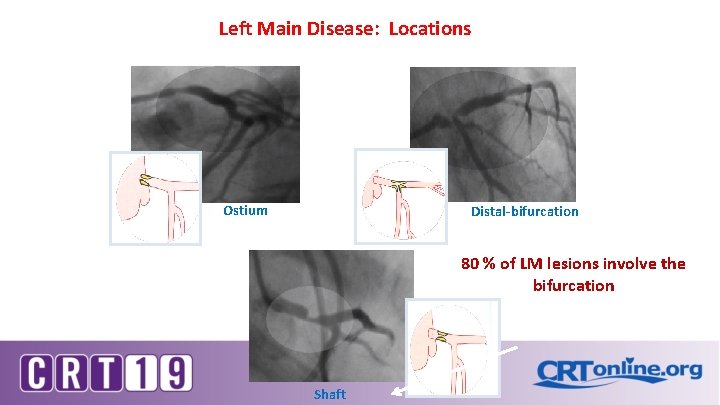 Left Main Disease: Locations Ostium Distal-bifurcation 80 % of LM lesions involve the Left Main Disease: Locations Ostium Distal-bifurcation 80 % of LM lesions involve the
