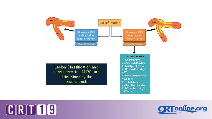 Lesion Classification and approaches to LM PCI are determined by the Side Branch Minor Lesion Classification and approaches to LM PCI are determined by the Side Branch Minor