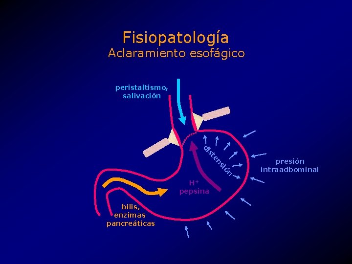 Fisiopatología Aclaramiento esofágico peristaltismo, salivación ón si en st di H+ pepsina bilis, enzimas