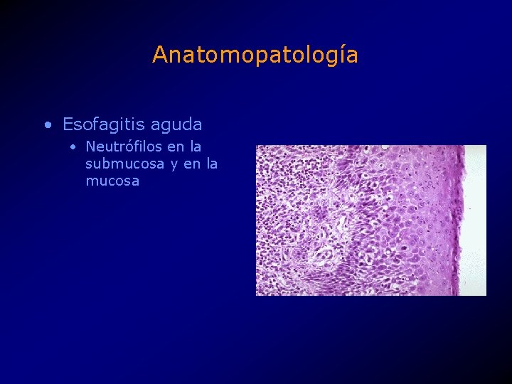 Anatomopatología • Esofagitis aguda • Neutrófilos en la submucosa y en la mucosa 