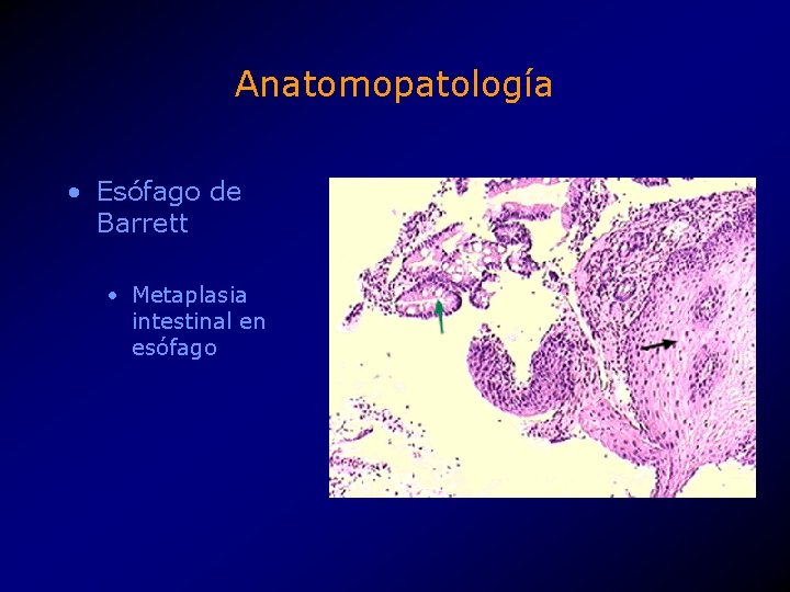 Anatomopatología • Esófago de Barrett • Metaplasia intestinal en esófago 