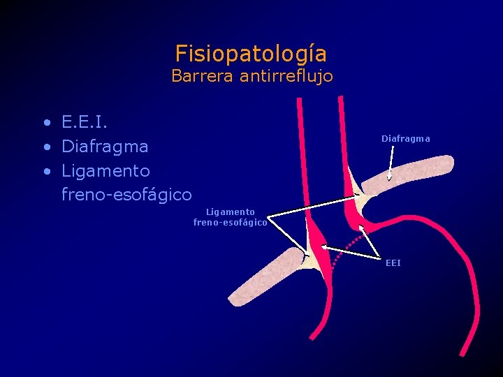 Fisiopatología Barrera antirreflujo • E. E. I. • Diafragma • Ligamento freno-esofágico Diafragma Ligamento