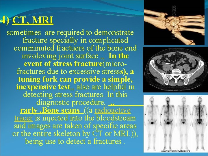 4) CT, MRI sometimes are required to demonstrate fracture specially in complicated comminuted fractuers 4) CT, MRI sometimes are required to demonstrate fracture specially in complicated comminuted fractuers