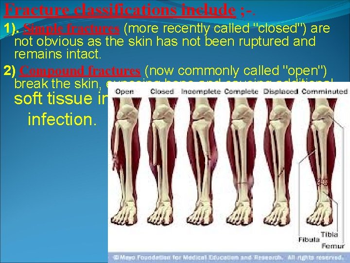 Fracture classifications include ; -. 1). Simple fractures (more recently called "closed") are not Fracture classifications include ; -. 1). Simple fractures (more recently called "closed") are not