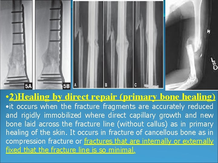 • 2)Healing by direct repair (primary bone healing) • it occurs when the • 2)Healing by direct repair (primary bone healing) • it occurs when the