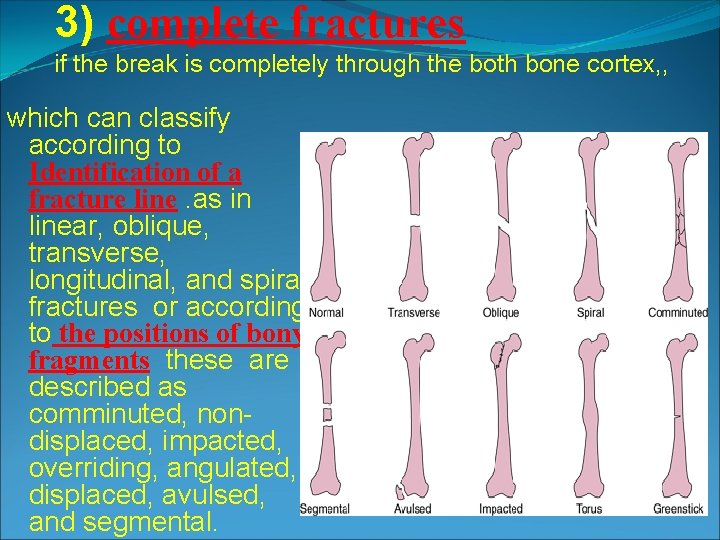 3) complete fractures if the break is completely through the both bone cortex, , 3) complete fractures if the break is completely through the both bone cortex, ,